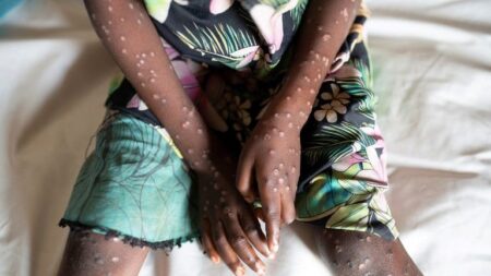 ECOWAS Warns of Health Crisis as Mpox Cases Surge in Africa