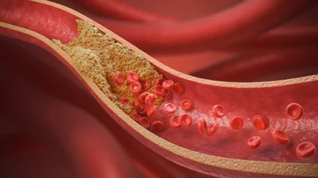 10 Warning Signs of Clogged Arteries You Shouldn’t Ignore