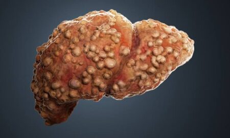 What you should know about liver cancer