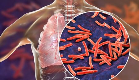 Funding cuts threaten global tuberculosis fight Tuberculosis