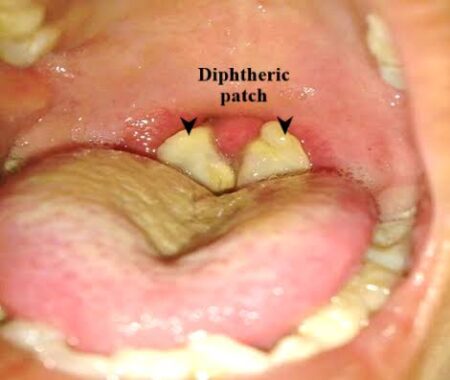 diphtheria