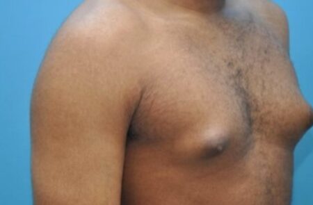 Expert reveals men with large breasts at higher risk of breast cancer Man with large breast