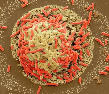 5 overlooked symptoms of bowel cancer that often mimic everyday illnesses Cancer
