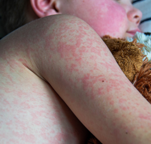 Canada faces worst measles outbreak in decades, threatening Americas’ elimination status Measles