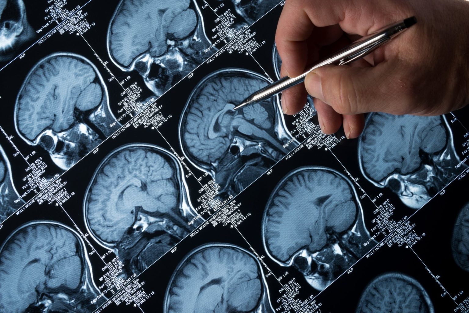 Alzheimer’s drug rejected by NHS shows patients holding memory for four years X-ray of human brain